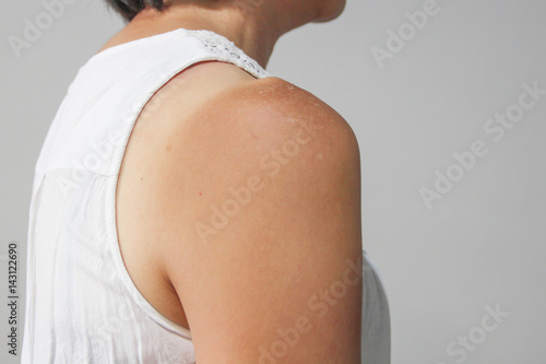 Sunburn shoulder