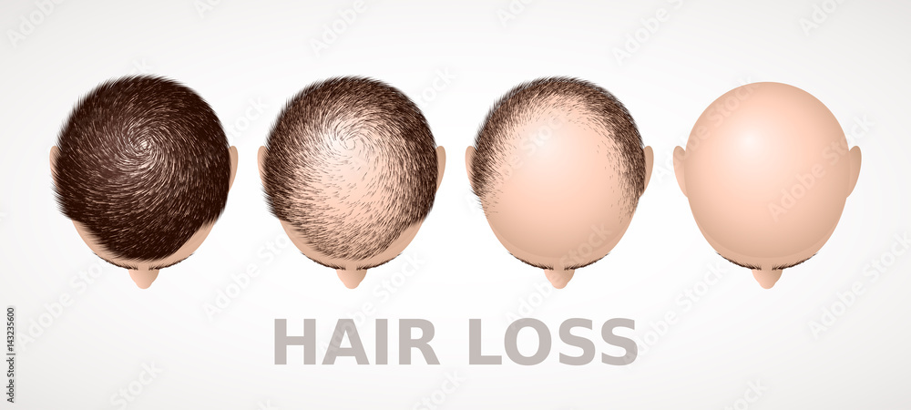 Hair loss. Set of four stages of alopecia - obrazy, fototapety, plakaty 