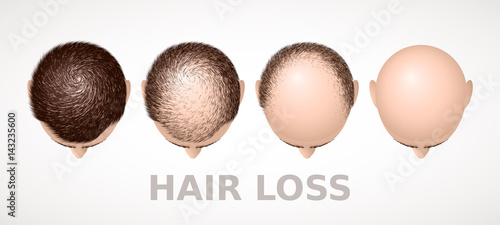 Hair loss. Set of four stages of alopecia photo