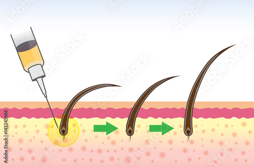 Hair follicle treatment of people have a hair loss problem with medical method.