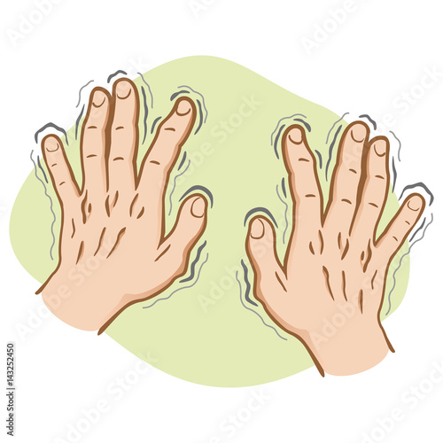 Close part of the body, pair of hands shaking symptoms of, Parkinson's disease, cold or fear, Caucasian. Ideal for educational and institutional and medical materials