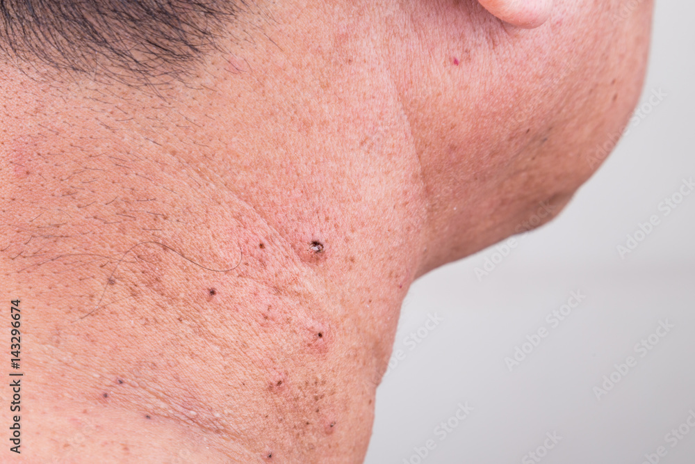 Mole removed via skin graft procedure leaving scar Mole removed via skin graft procedure leaving scar