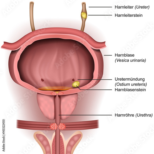 Blasenstein, Harnleiterstein, vektor illustration mit beschreibung auf deutsch