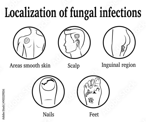 The localization of fungal infections