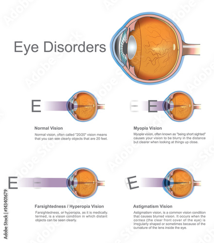 Eye disorders. Vector graphic.