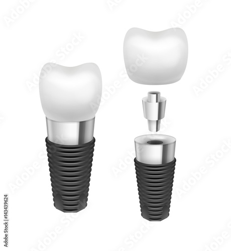Vector tooth implant