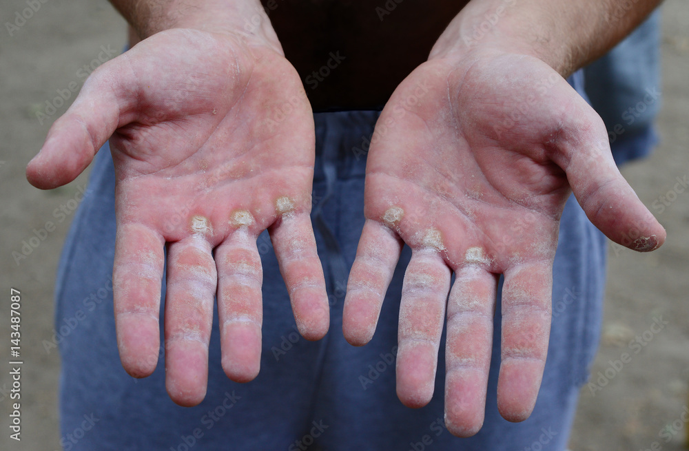 Corny sportsman hands palms with corns callosities / worker hands palms