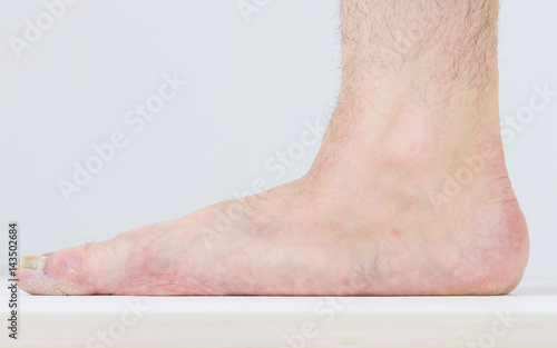 Men's right leg with severe symptoms of diseases of the feet. photo