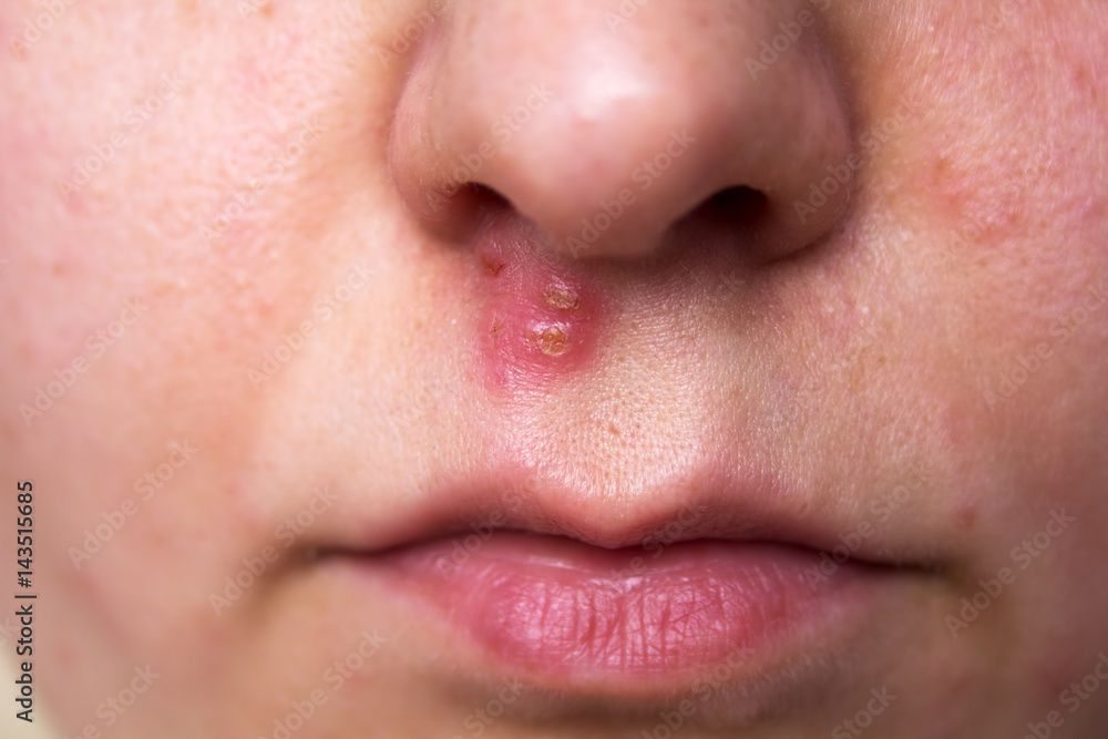 Fototapeta premium young girl with skin problem