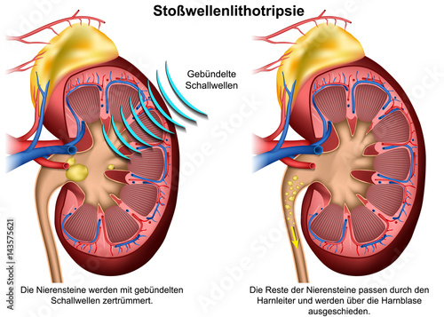 Stosswellenlithotripsie vektor illustration mit Erklärung auf deutsch
