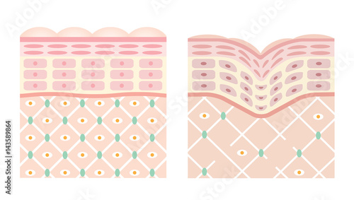 健康肌 しわ肌 断面図