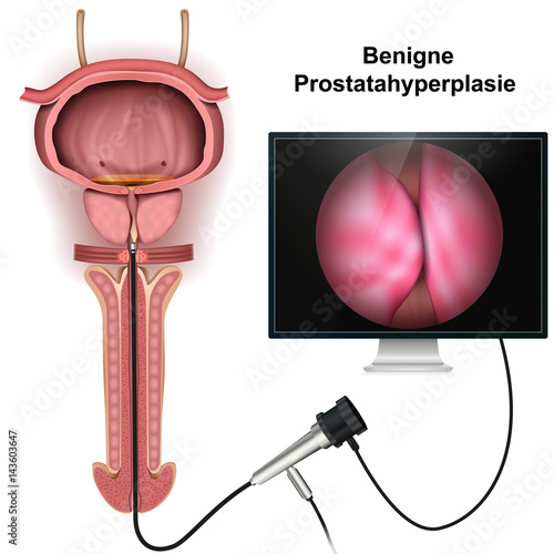 Benigne prostatahyperplasie, medical vector illustration