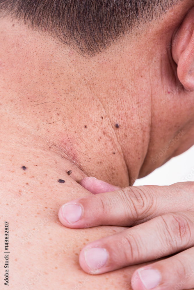 Finger embrace mole on neck and shoulder of Asian male Finger embrace mole on neck and shoulder of Asian male