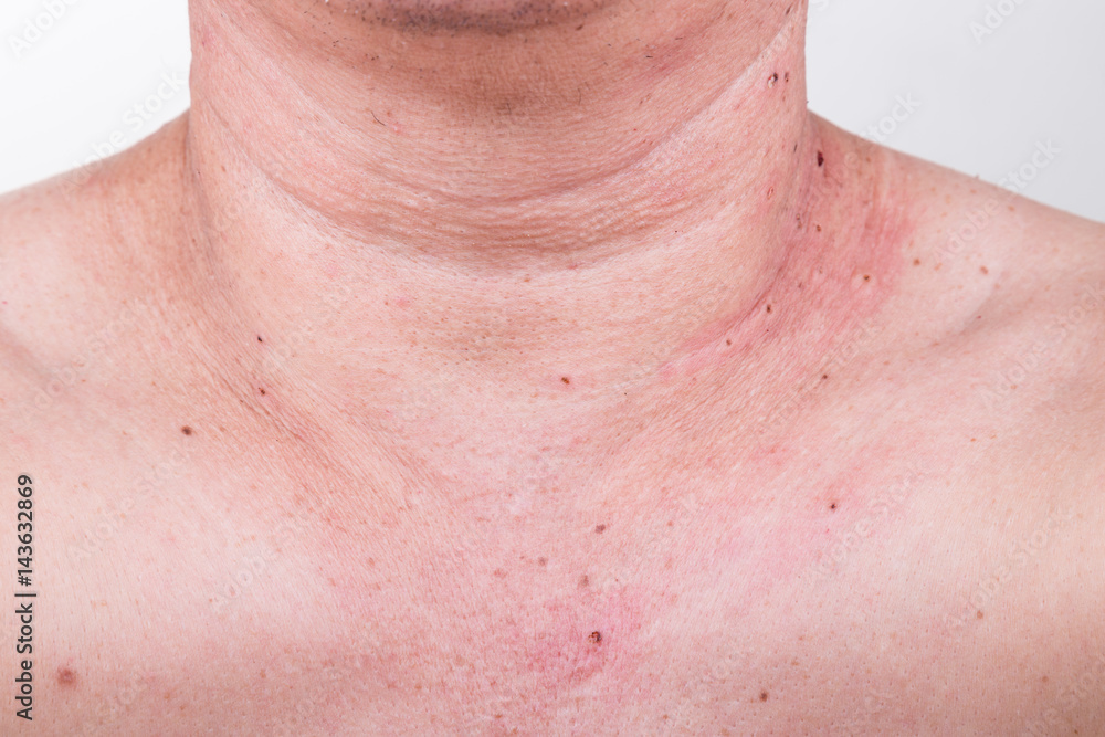 Naklejka premium Mole removed via skin graft procedure leaving scar