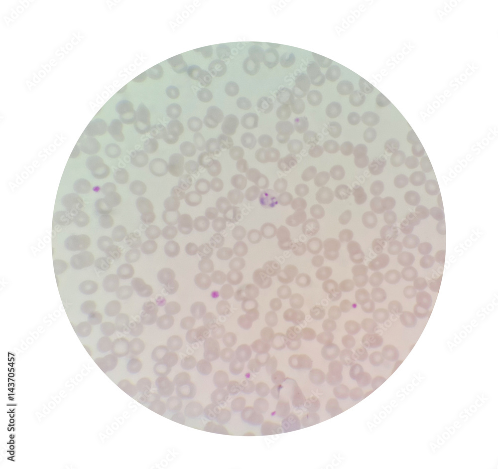 Microscopic examination of thin blood films smear from malaria infected patients present morphology of malaria parasite in human red blood cells. Microscopic examination of thin blood films smear from malaria infected patients present morphology of malaria parasite in human red blood cells.