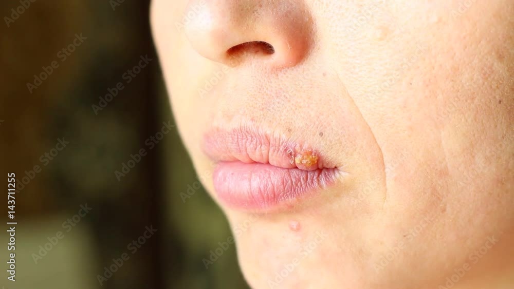 Herpes simplex is a viral disease caused by the herpes simplex virus. Oral herpes involves the