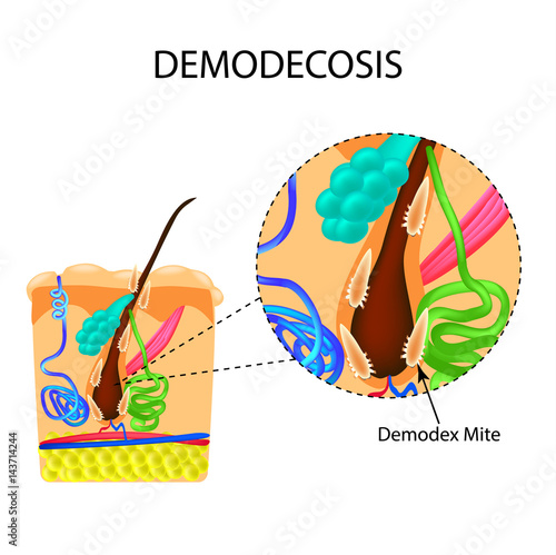 The structure of the hair. Sebaceous gland. Sweat gland. Introduction of demodex mite. Demodecosis. Infographics. Vector illustration on isolated background