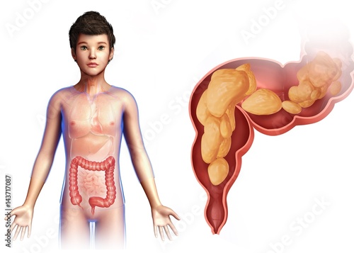 Child's rectum, illustration photo