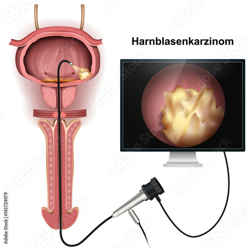 Harnblasenkarzinom Untersuchung, Zystoskopie vektor illustration