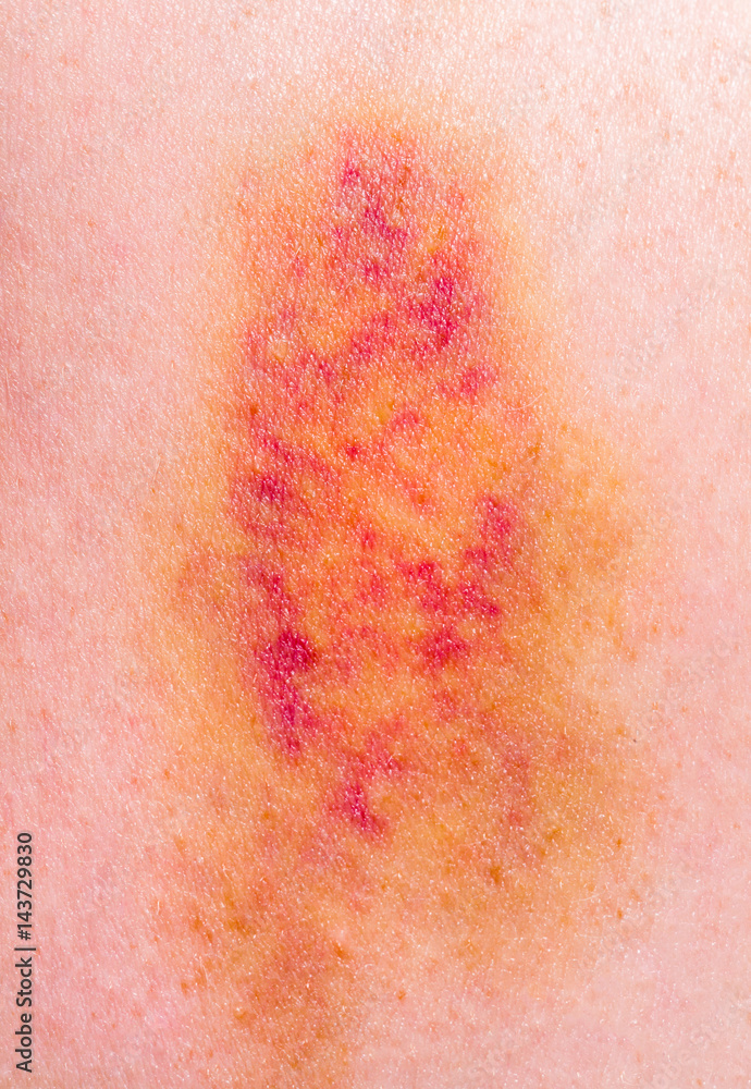 Fototapeta premium Closeup on a Bruise