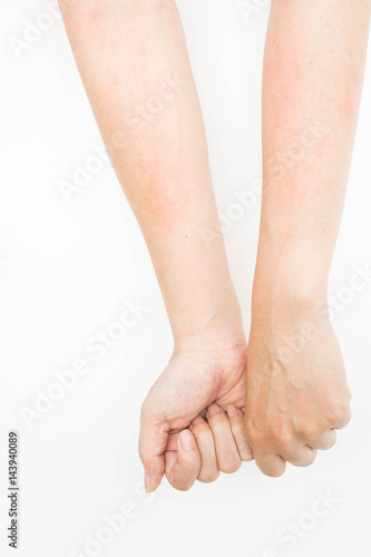 Rash allergy from touching arms ,eczema, Dermatitis