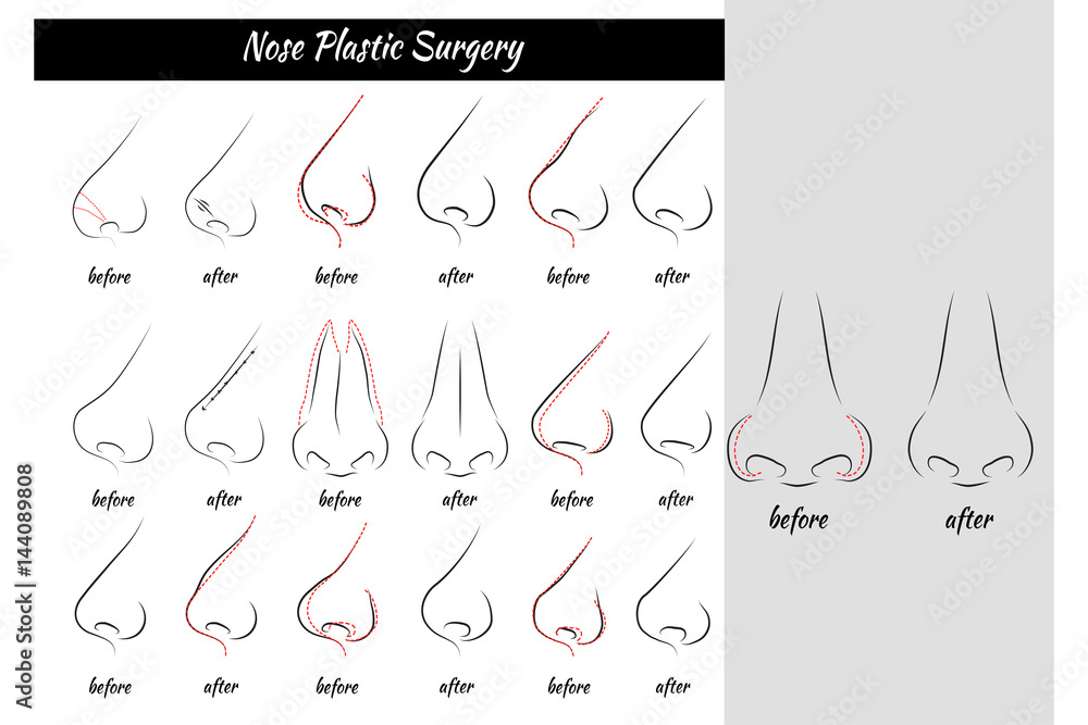 Plastic Surgery. Nose. Vector illustration. Nose Templates. Set of Plastic Surgery. Nose. Vector illustration. Nose Templates. Set of
