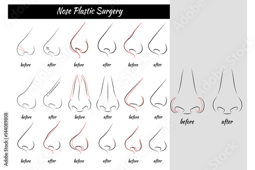 Plastic Surgery. Nose. Vector illustration. Nose Templates. Set of Noses.