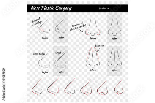 Plastic Surgery. Nose. Vector illustration. Nose Templates. Set of Noses.