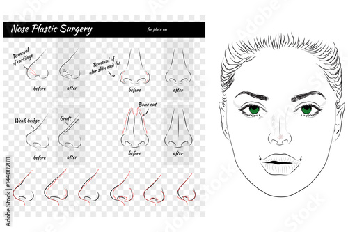 Plastic Surgery. Nose. Vector illustration. Nose Templates. Set of Noses. 
