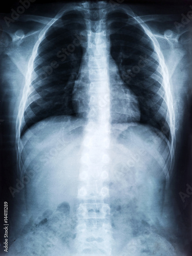 X-ray Film of Human Spine for Medical Diagnosis