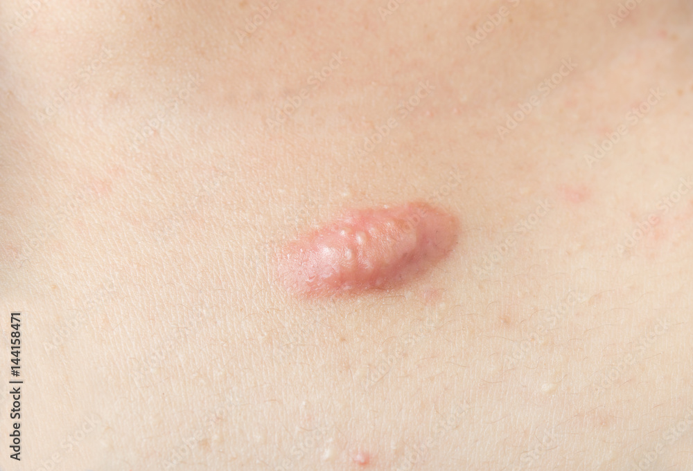 Fototapeta premium Scar on the chest