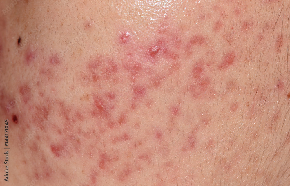 Fototapeta premium closeup skin problems, nodular cystic acne skin