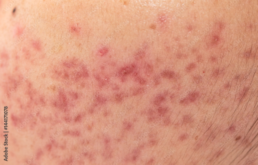 Fototapeta premium closeup skin problems, nodular cystic acne skin