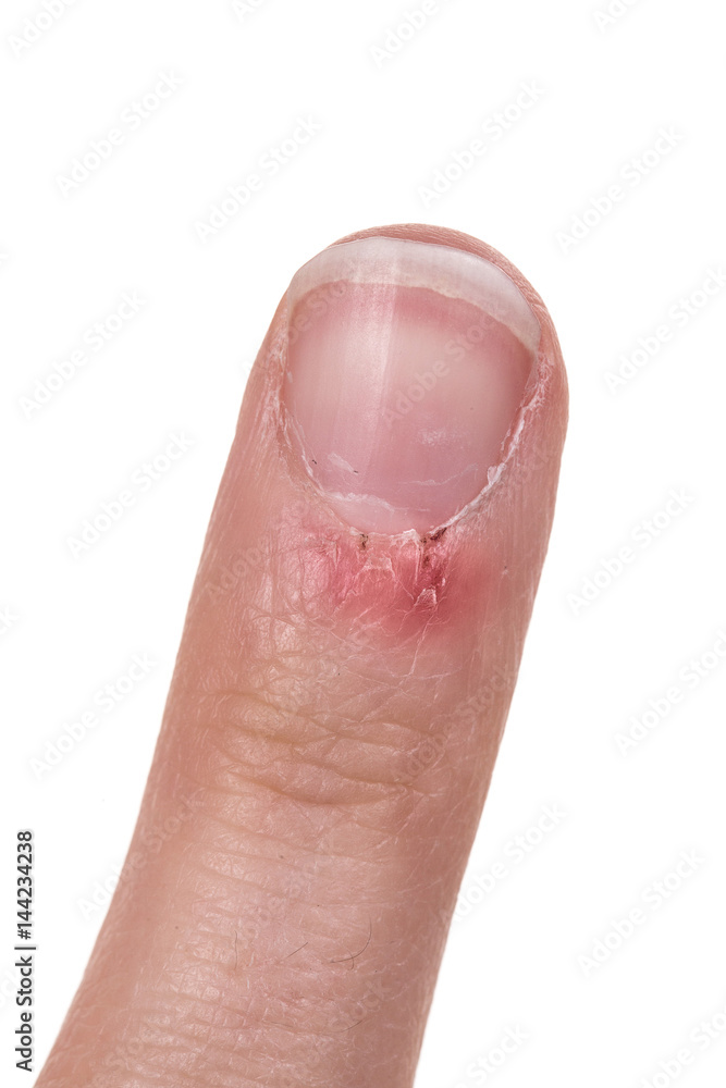 Flaky skin on the finger Flaky skin on the finger