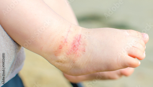 itchy dermatitis atopic baby foot photo