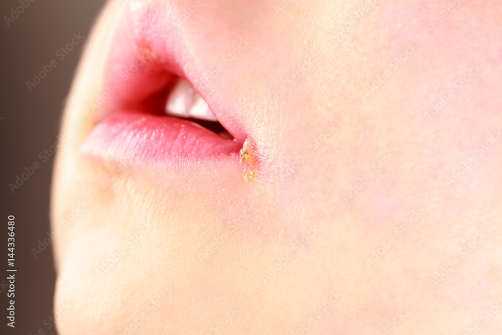 sore on the lip of the child . herpes foto de Stock Adobe Stock