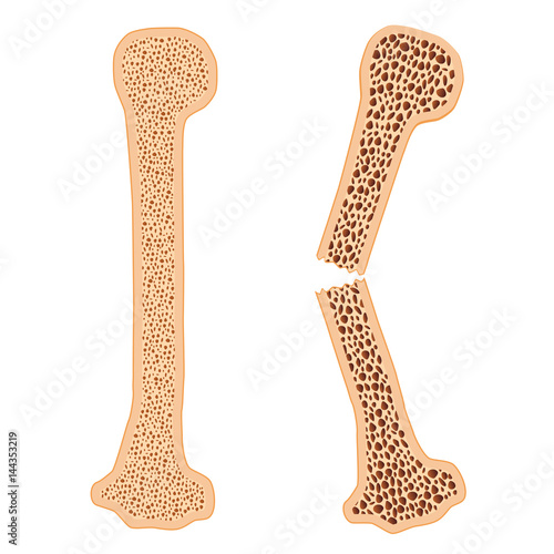Healthy bone and broken bone with osteoporosis.