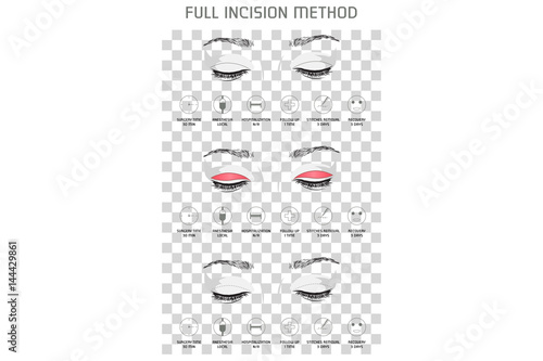 Full Incision Method. Vector Illustration. Medical Poster.