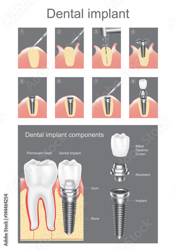 Dental implant. Vector graphic design.