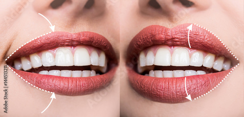 Contour plastic, augmentation of the lips, filling wrinkles, changing shape volume of lips, rejuvenating upper lip. Injections of hyaluronic acid for sexy lips. Beauty Salon or Plastic Surgeon