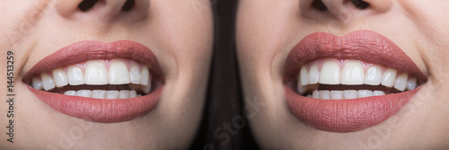Lip filler injections before and after. Lips Fillers and botox injections. Lip augmentation. Beautiful Perfect Lips. Sexy Mouth close up. Sexy plump lips after filler injection and syringe injection 