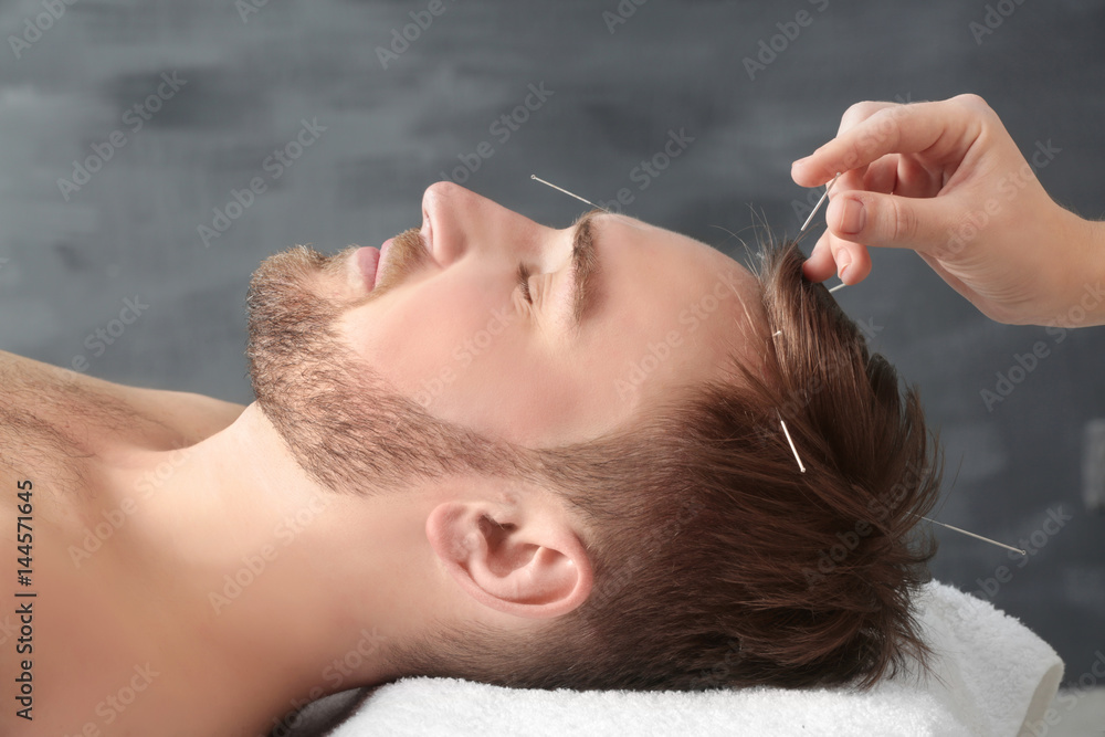 Young man getting acupuncture treatment, closeup - obrazy, fototapety, plakaty 