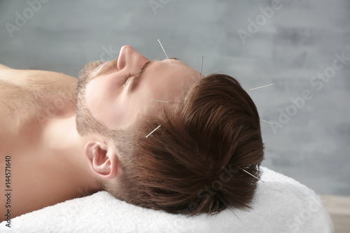 Young man getting acupuncture treatment, closeup