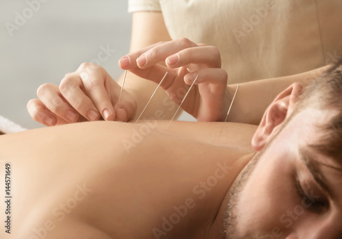 Young man getting acupuncture treatment, closeup