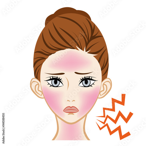 Sunburn Dermatitis  -Skincare Trouble