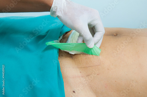 Doctor removing gauze from Cesarean Section wound in the hospital. abdominal