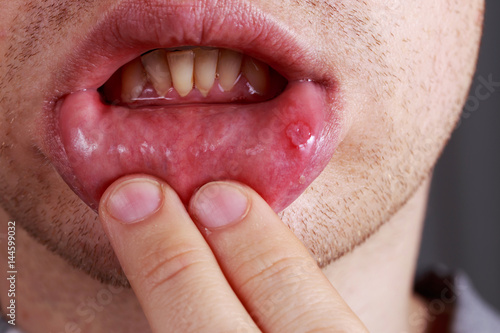 Stomatitis on the lips photo