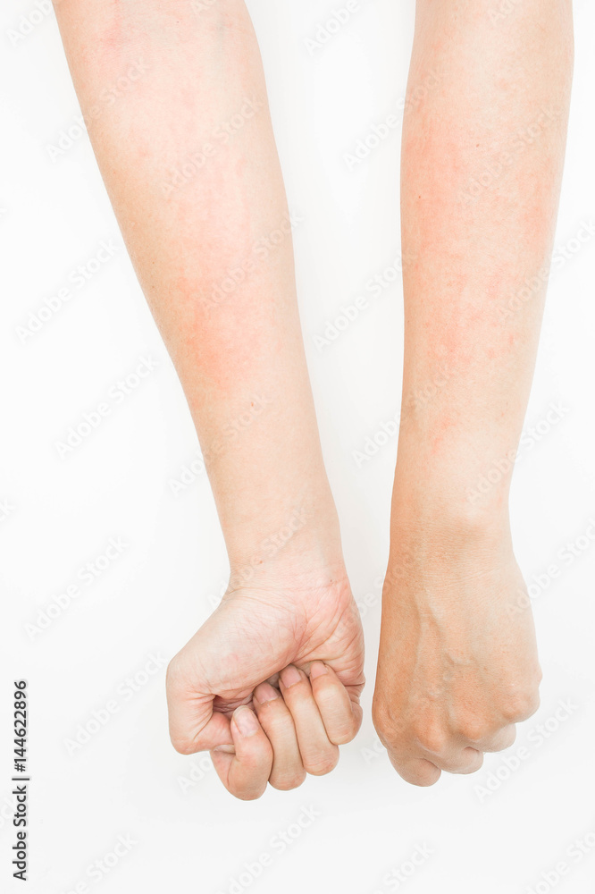Rash allergy from touching arms ,eczema, Dermatitis Rash allergy from touching arms ,eczema, Dermatitis