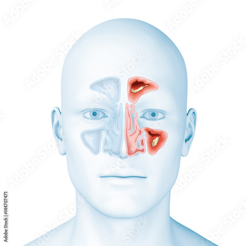 Paranasal sinusitis, medical illustration photo
