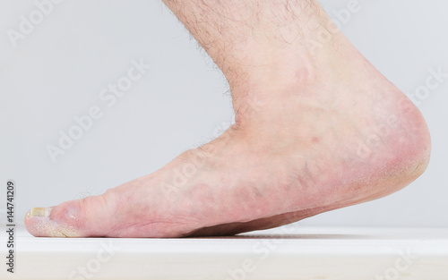 Men s right leg with severe symptoms of diseases of the feet.